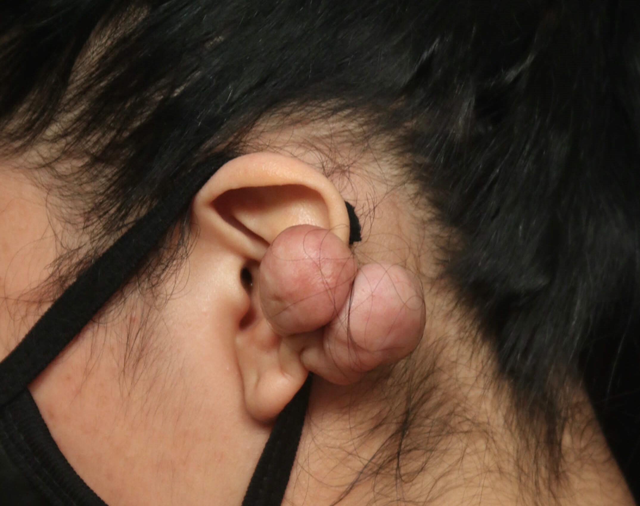 Before & After Scar Revision Before