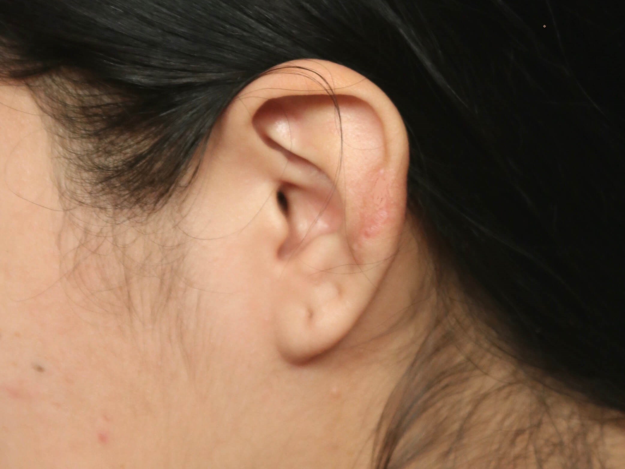 Before & After Scar Revision After