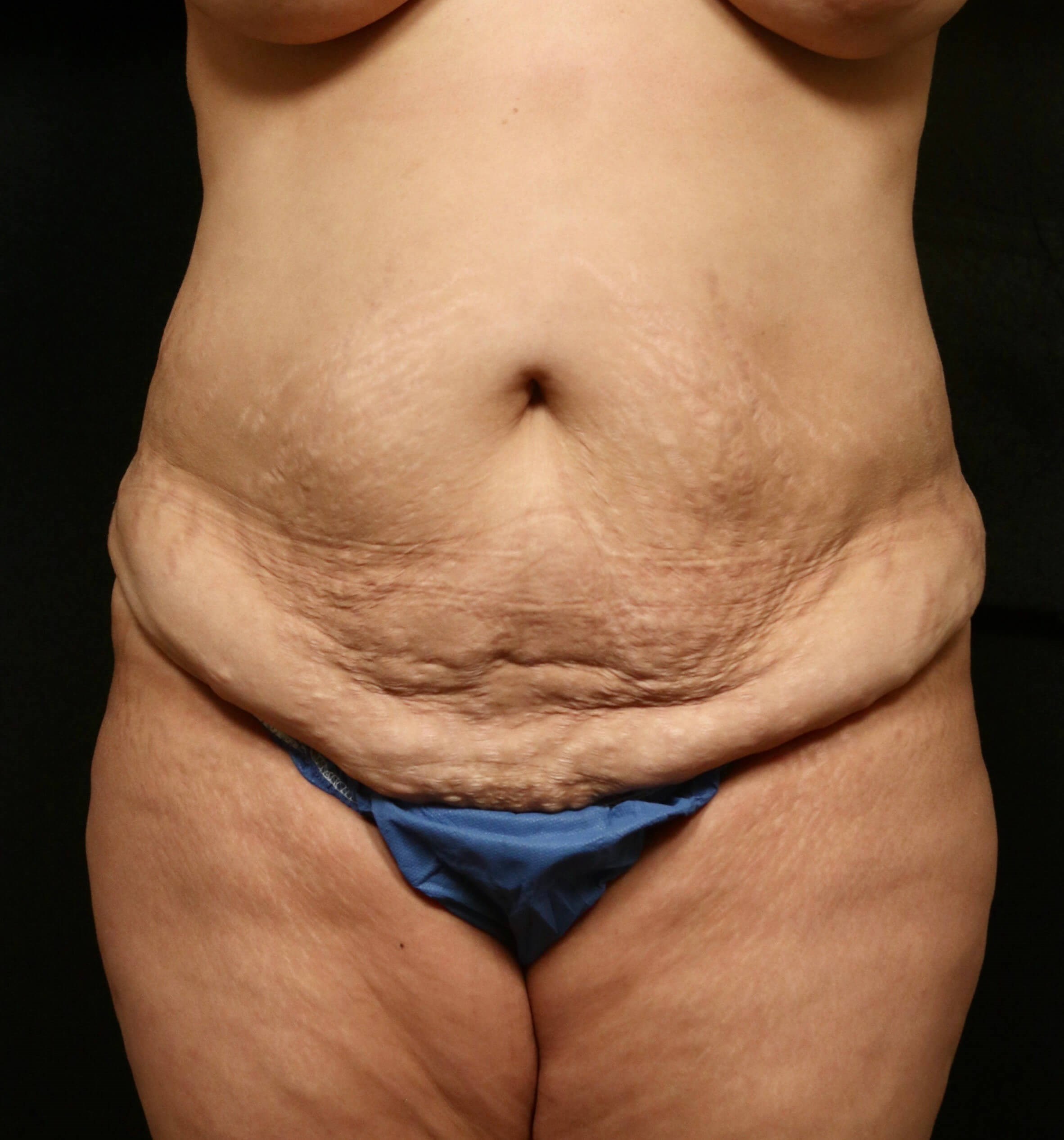 Tummy Tuck Front Results Before