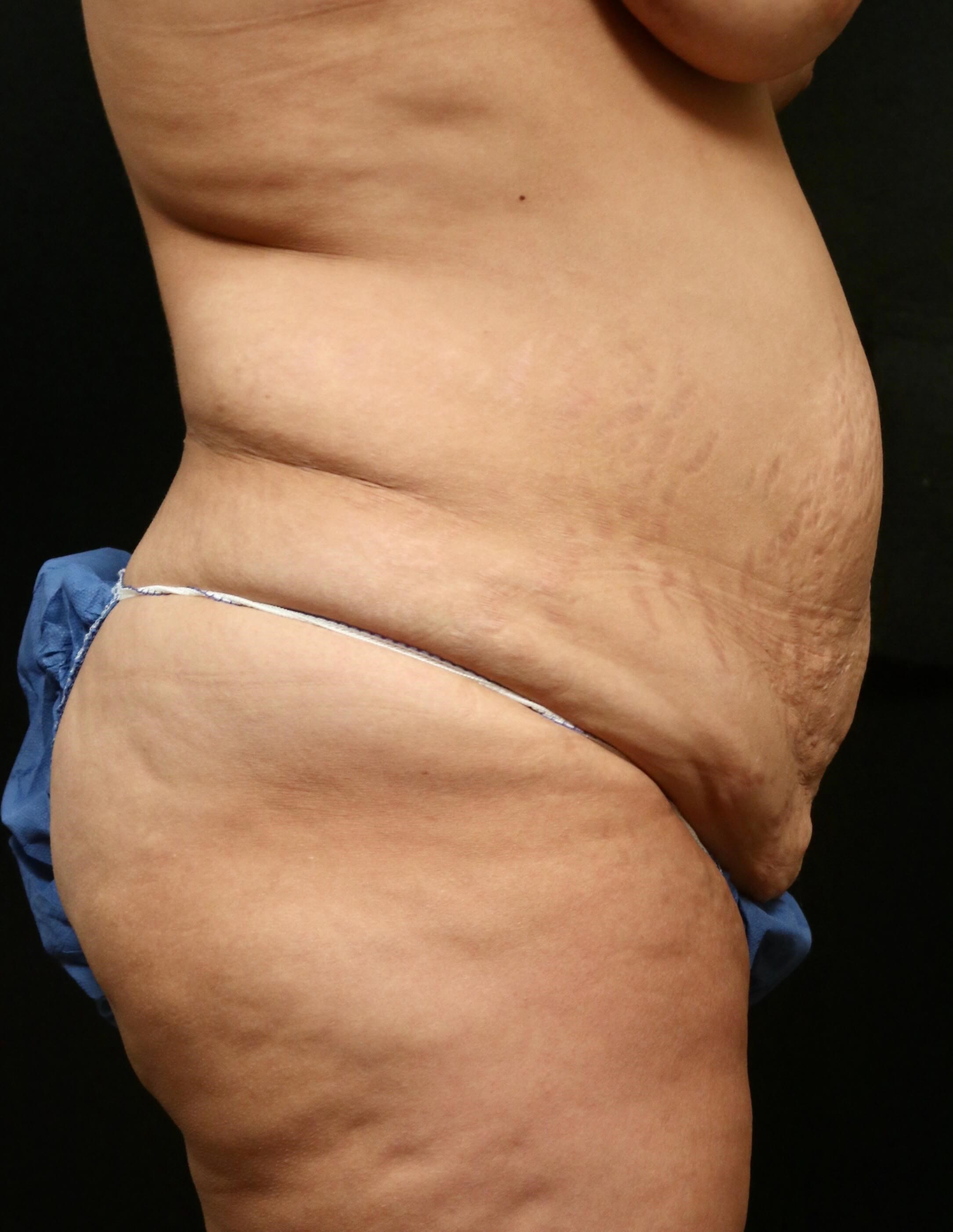 Tummy Tuck Side  Results Before