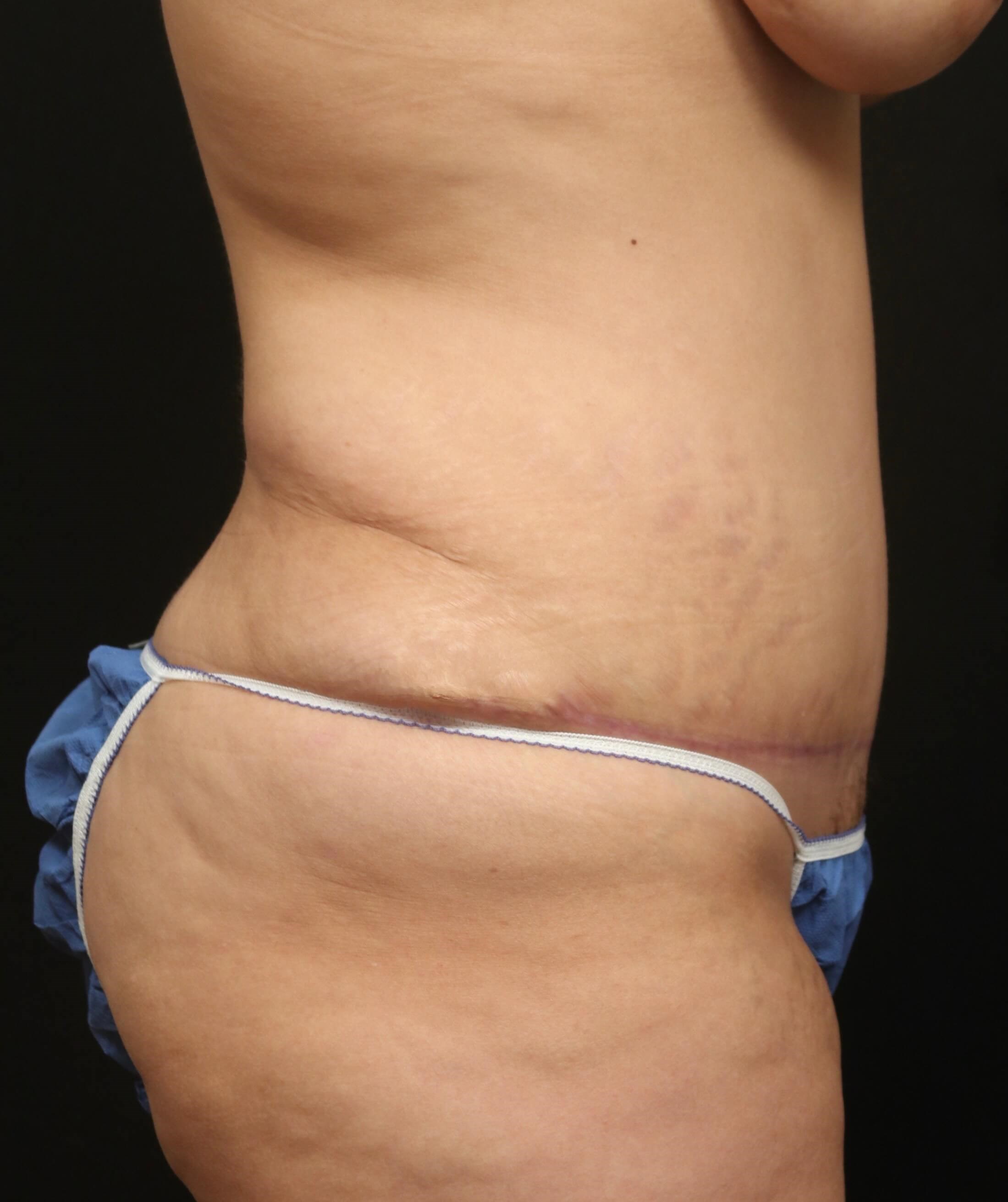 Tummy Tuck Side  Results After