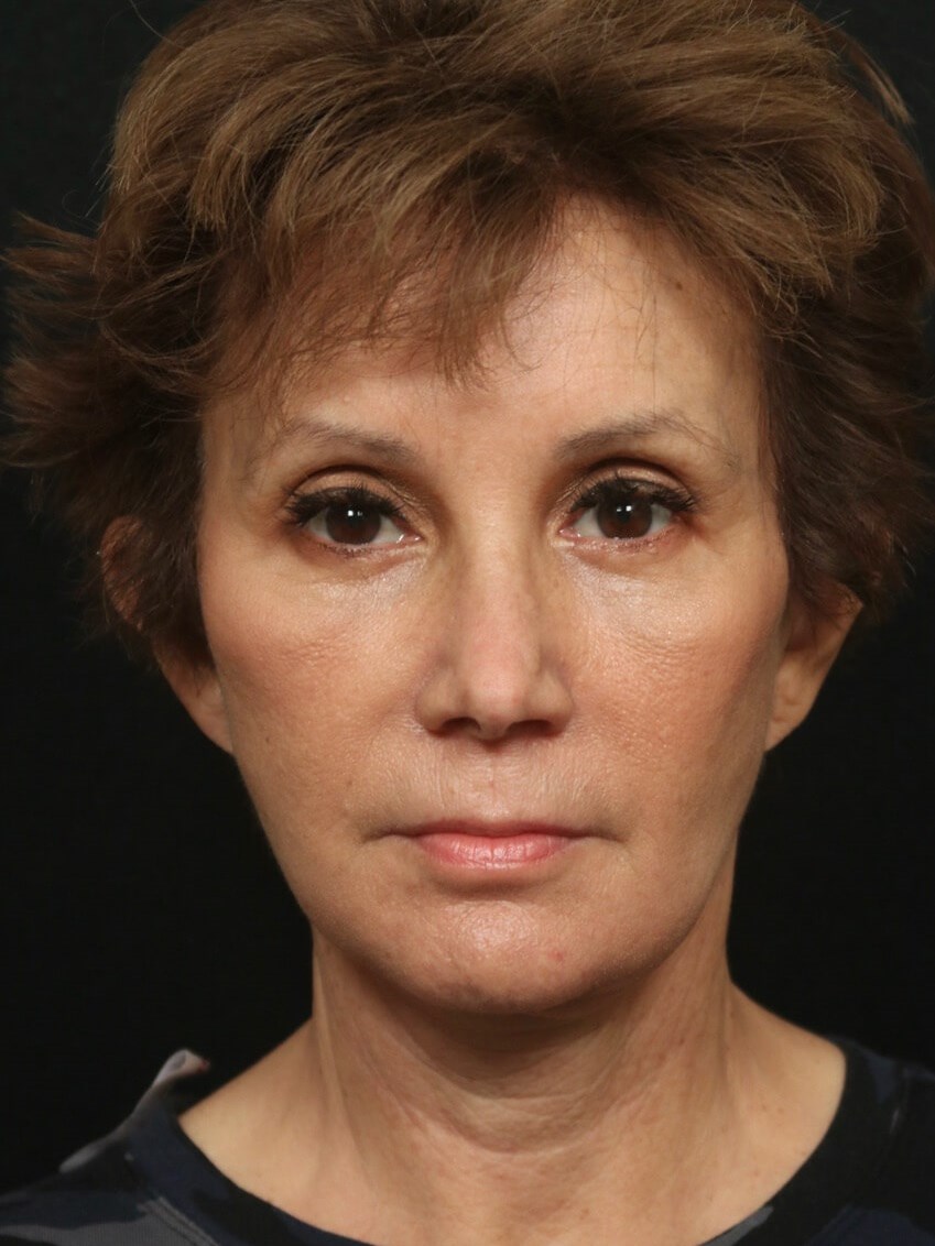 Facelift Before and After After