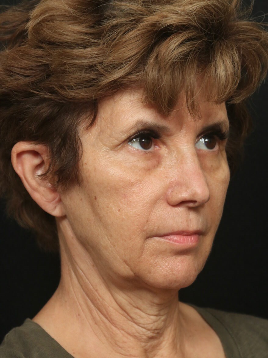 Facelift Before and After Before