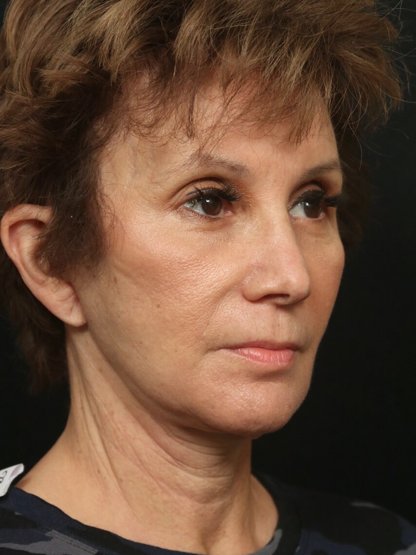 Facelift Before and After After