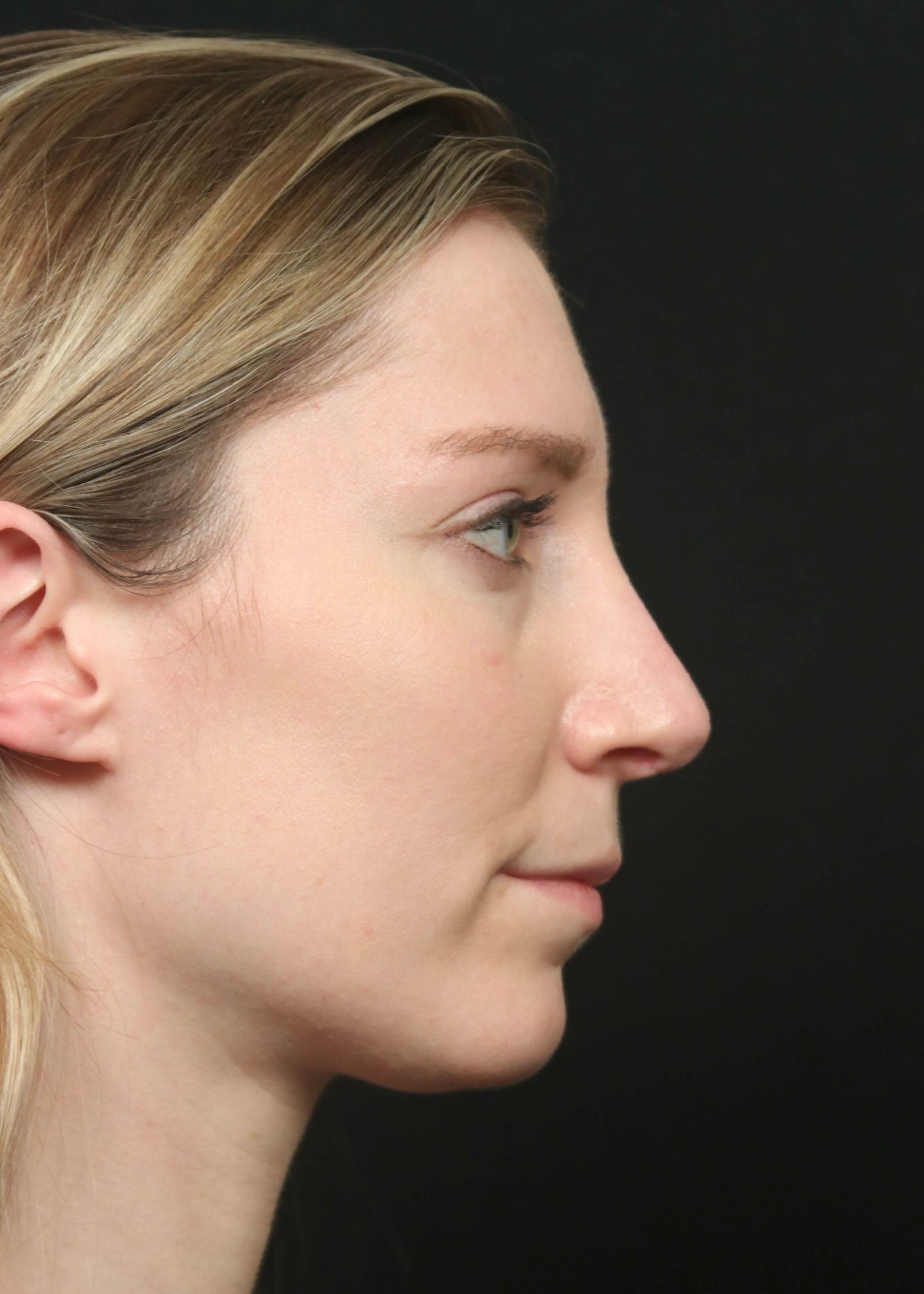 Rhinoplasty Before And After After