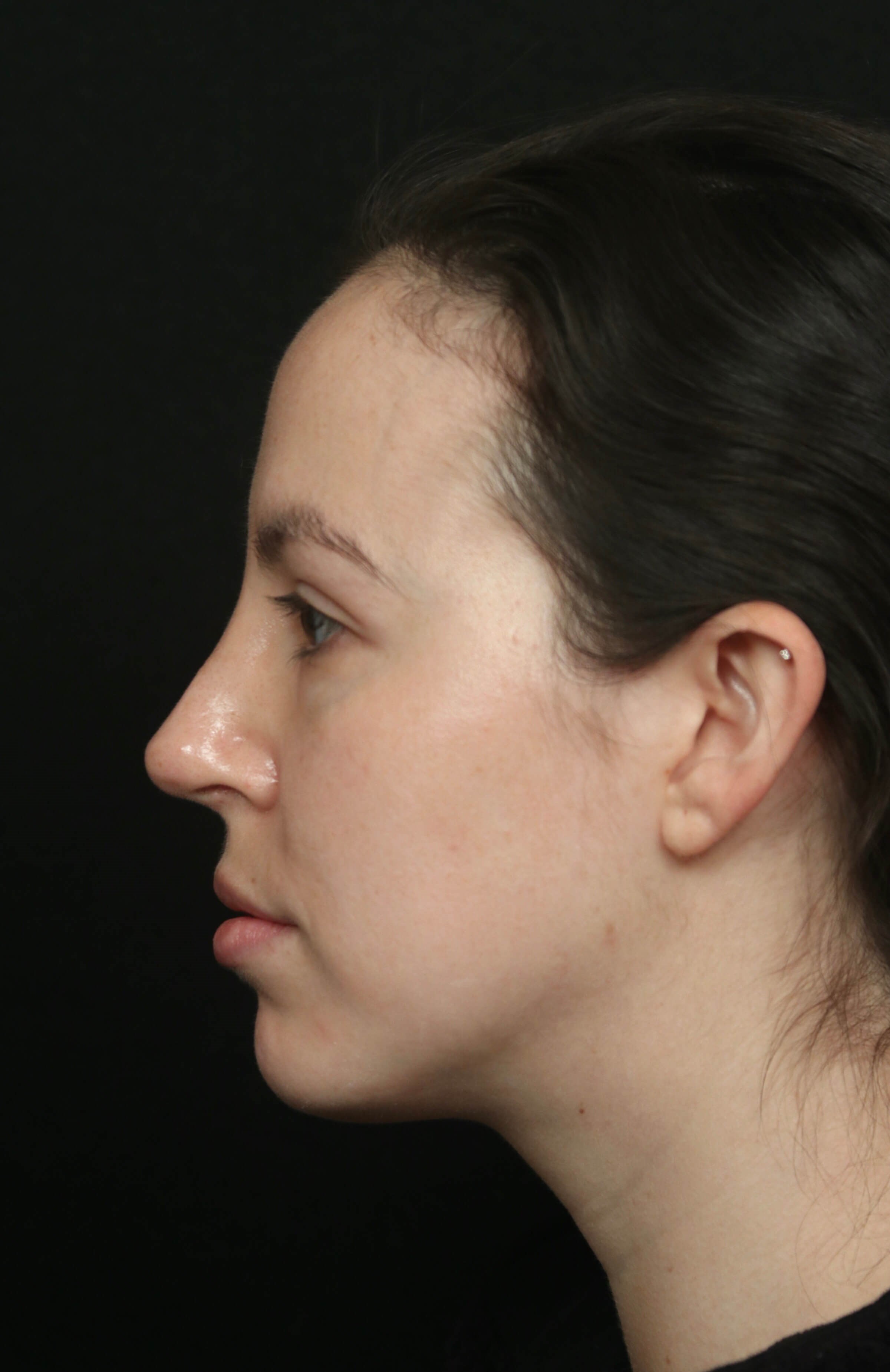 Rhinoplasty Before and After After