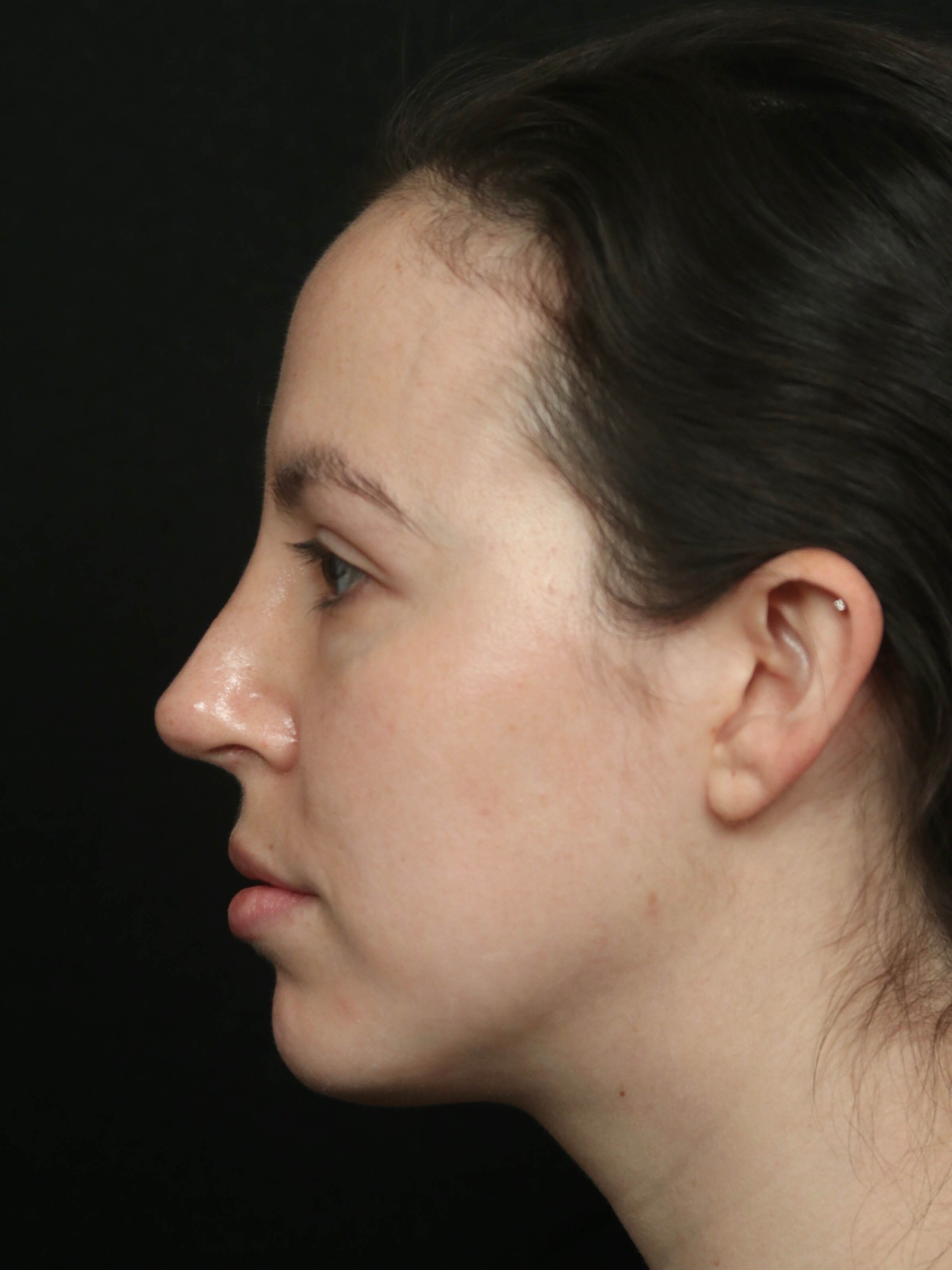 Rhinoplasty Before and After After