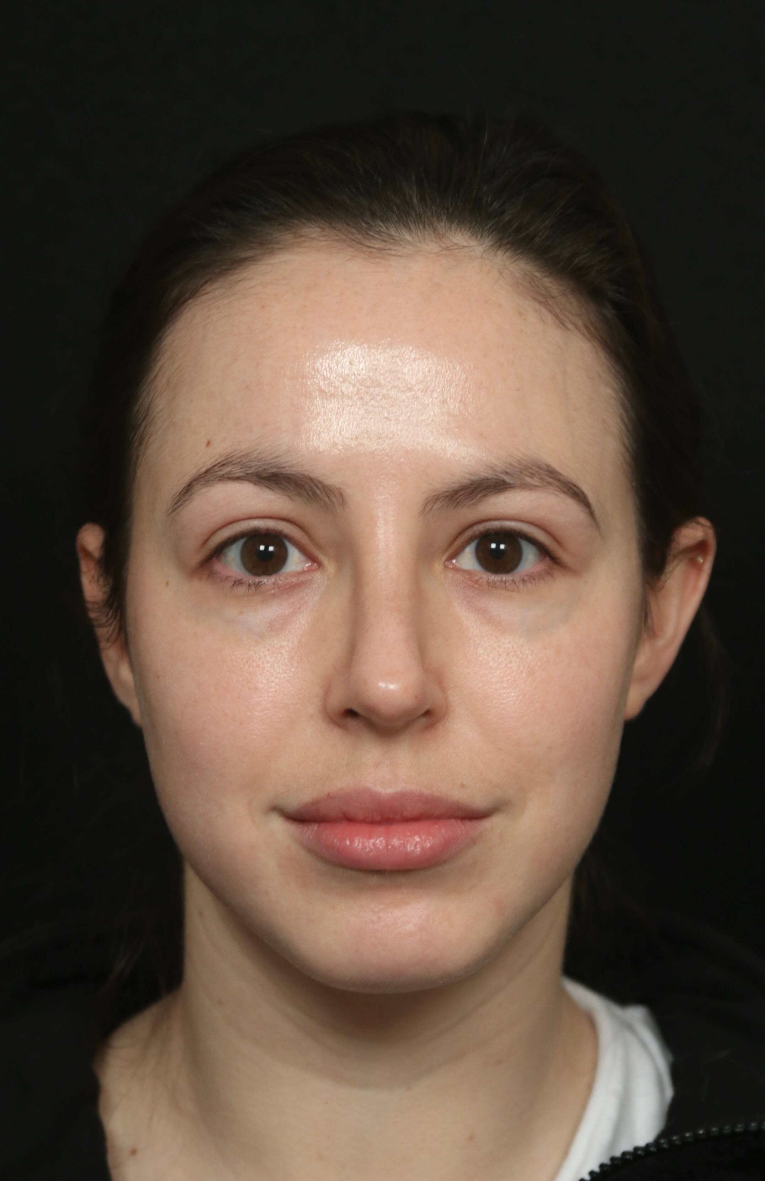 Rhinoplasty Before and After After