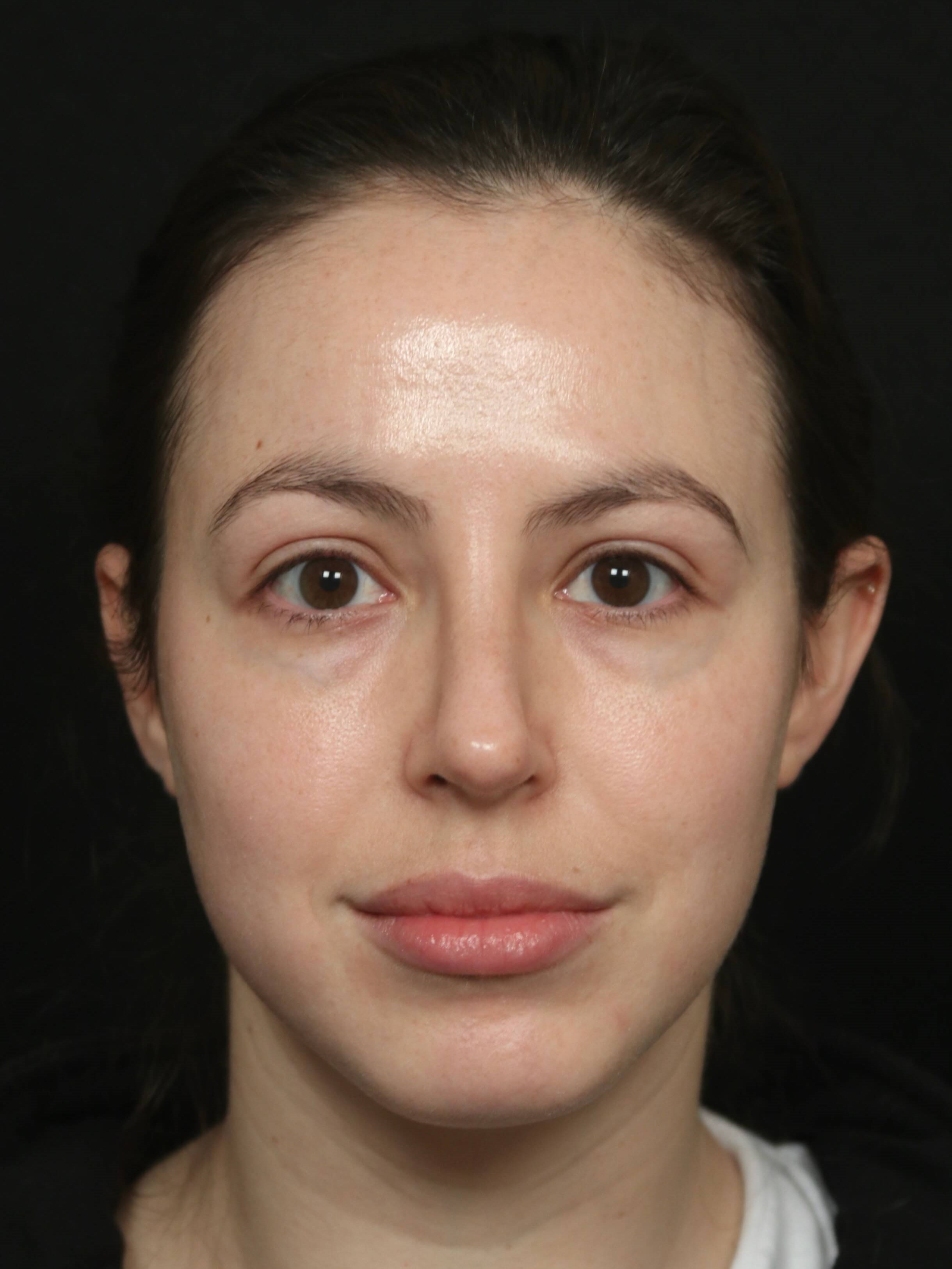Rhinoplasty Before and After After