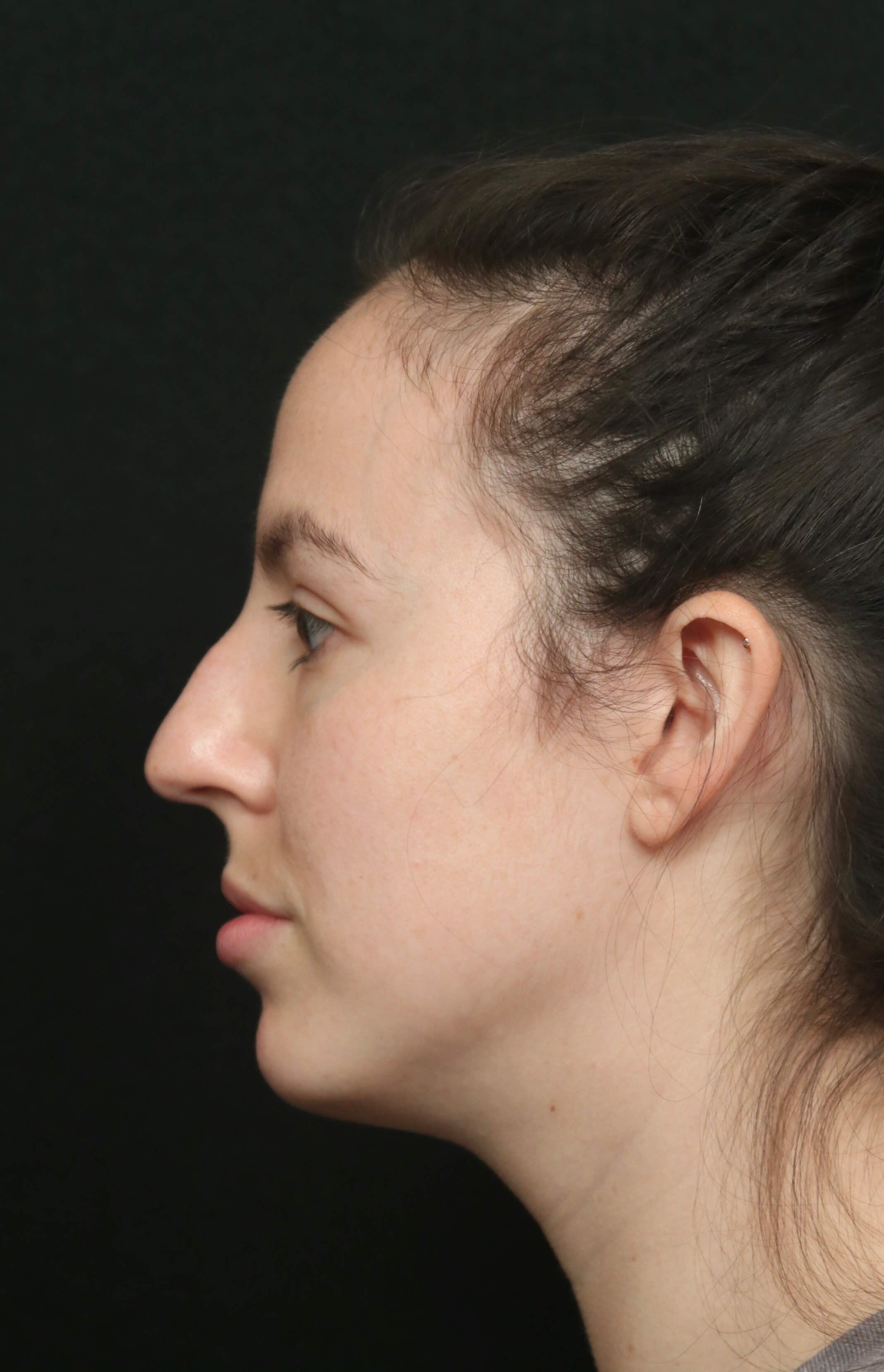 Rhinoplasty Before and After Before