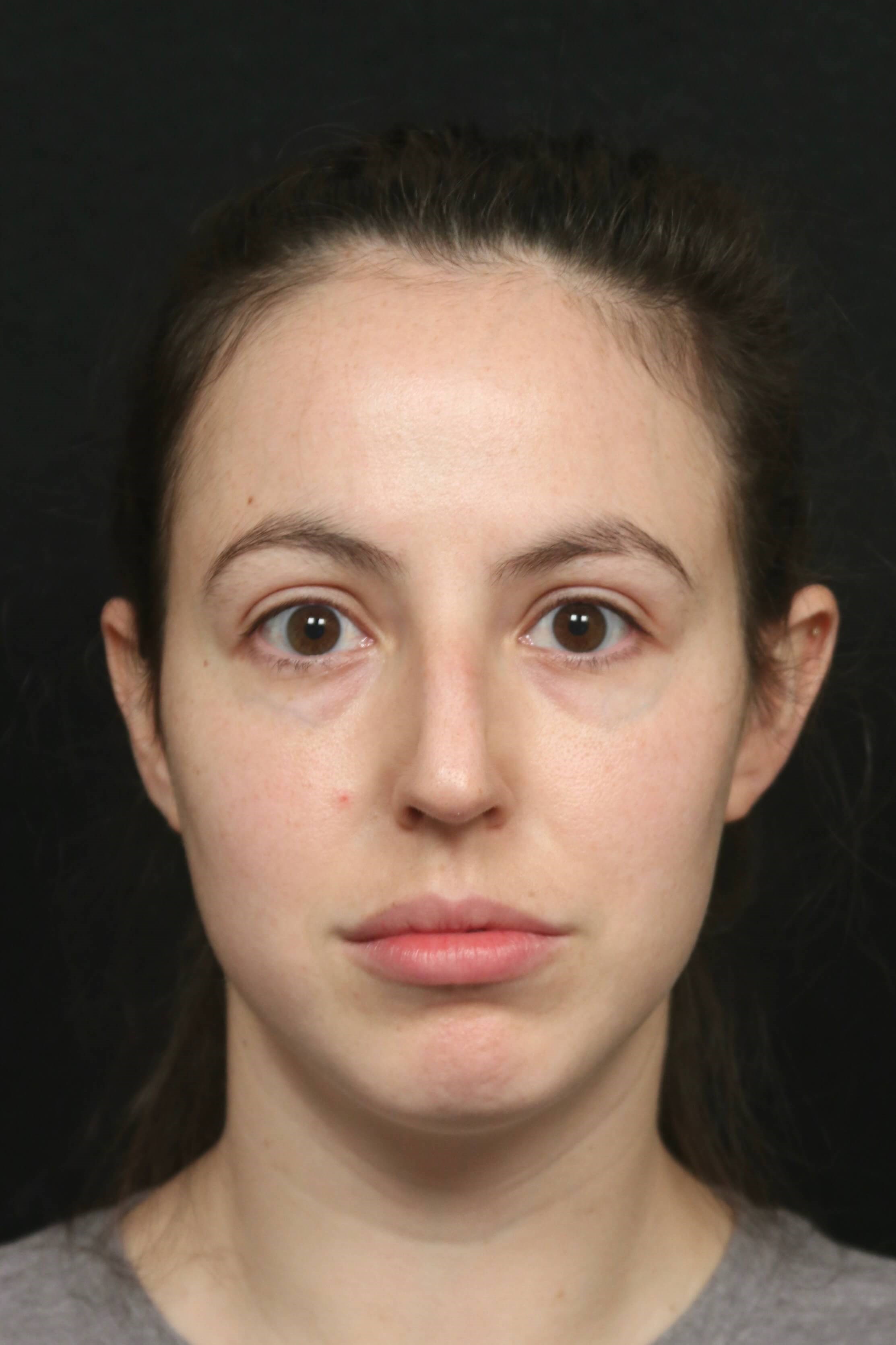 Rhinoplasty Before and After Before