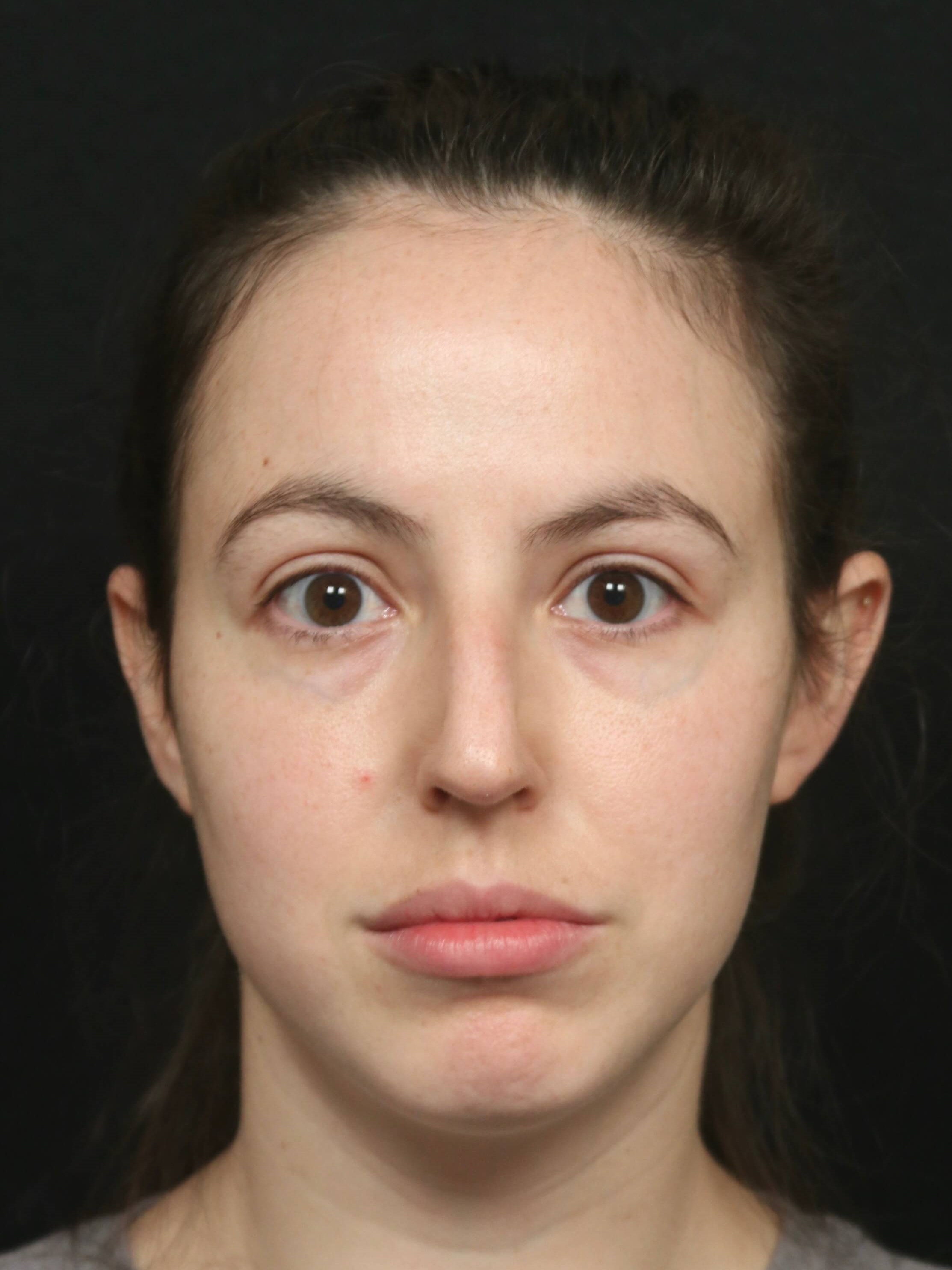 Rhinoplasty Before and After Before