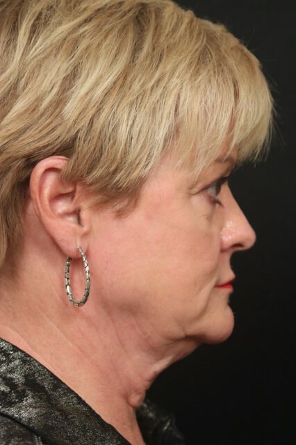 Facelift Before And After Before