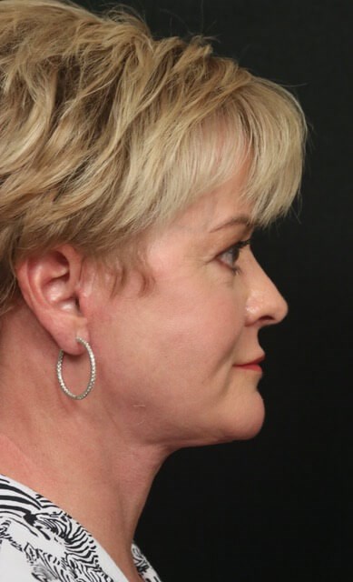 Facelift Before And After After