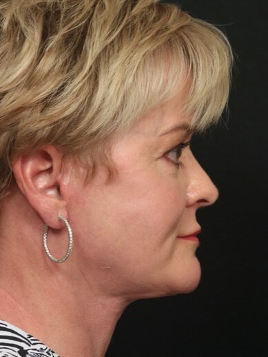 Facelift Before And After After