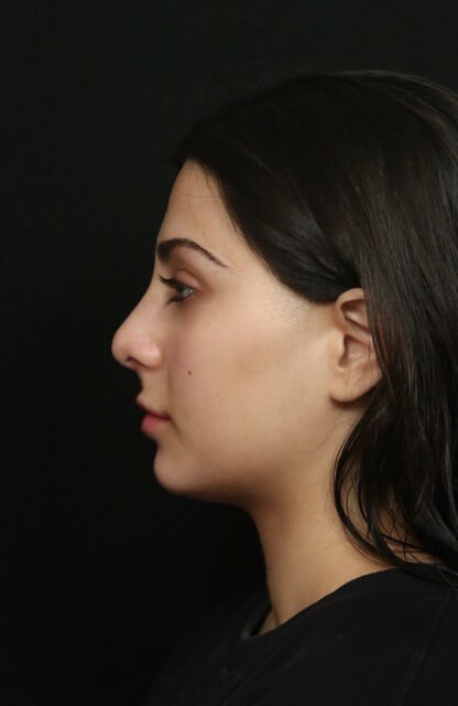Rhinoplasty Before and After After