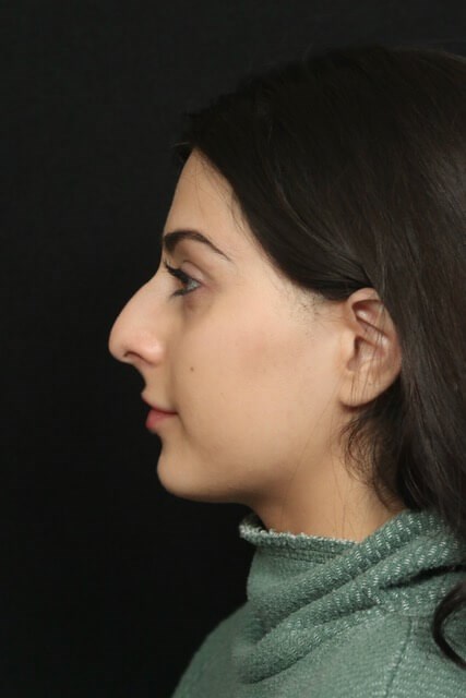 Rhinoplasty Before and After Before
