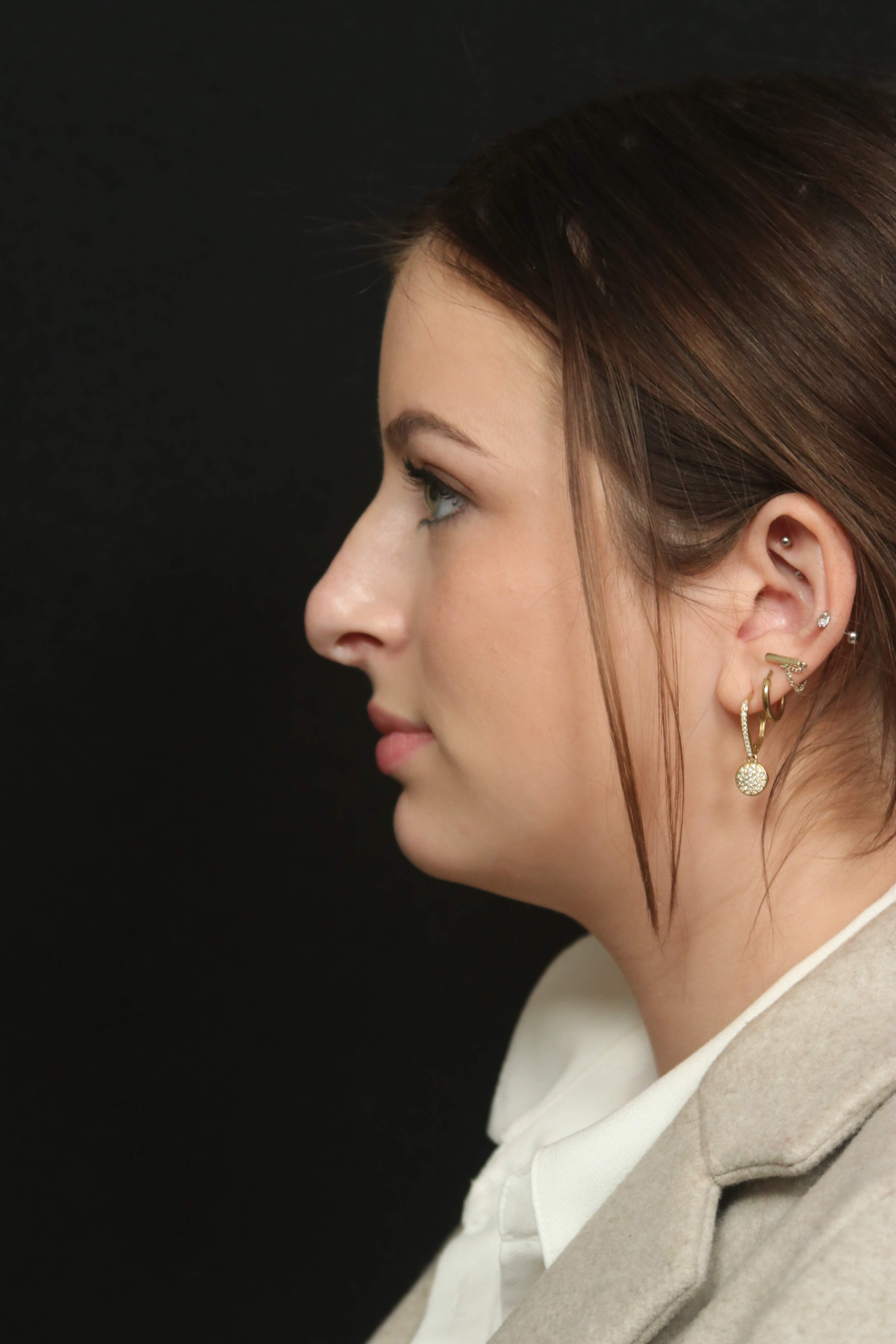 Rhinoplasty Before and After Before