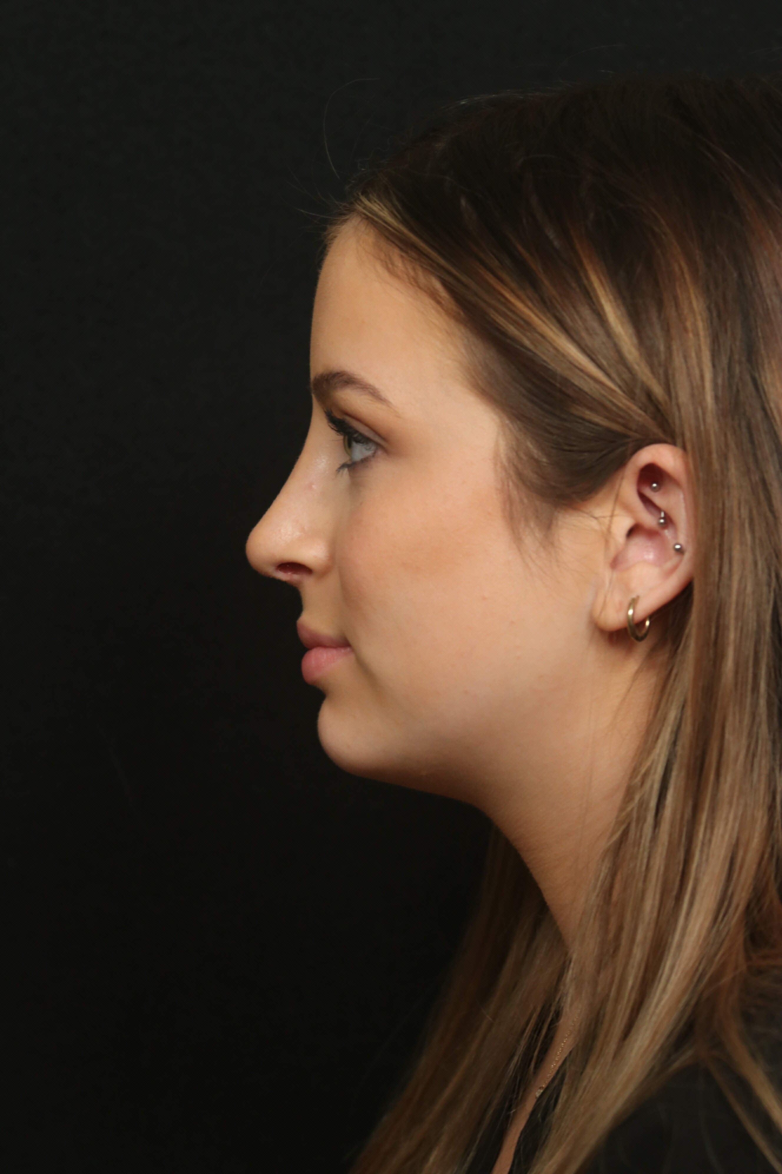 Rhinoplasty Before and After After
