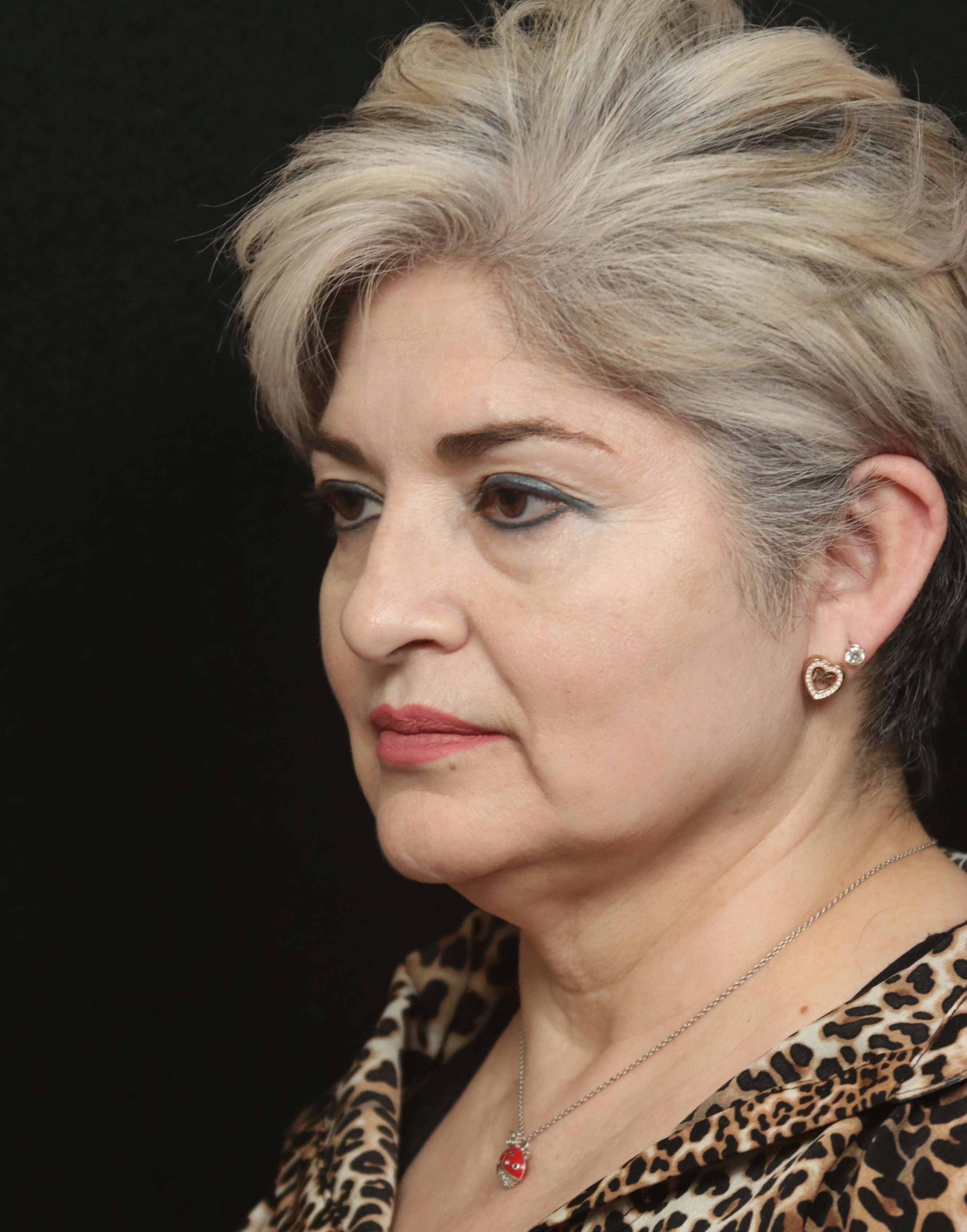 Facelift Before and After Before