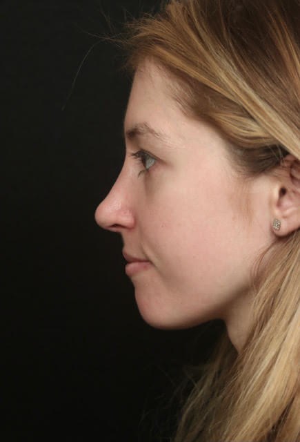 Rhinoplasty Before and After After