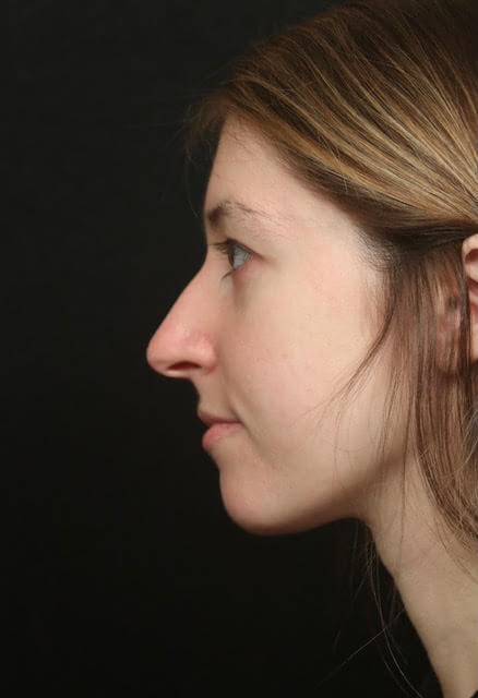 Rhinoplasty Before and After Before