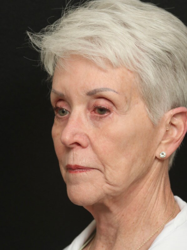 Before and After Facelift Before