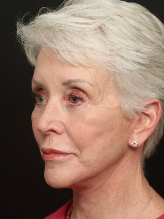 Before and After Facelift After