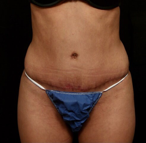Tummy Tuck Before and After After