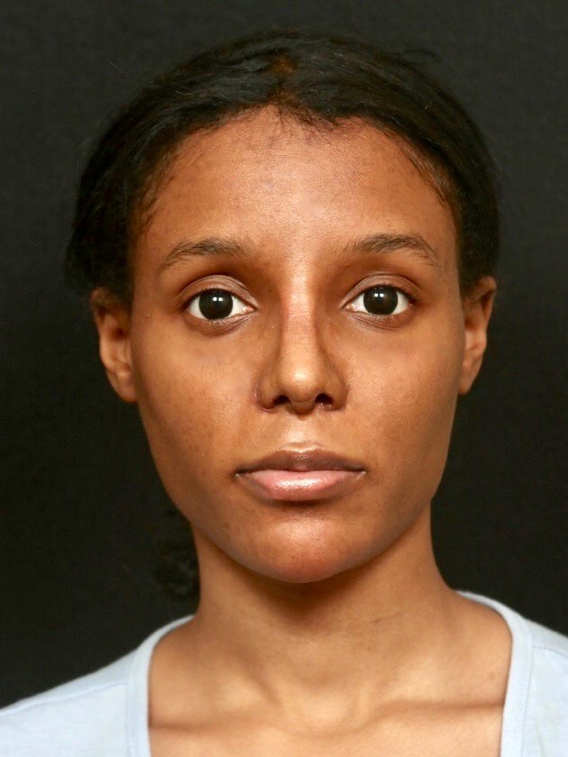 Rhinoplasty with Implant After