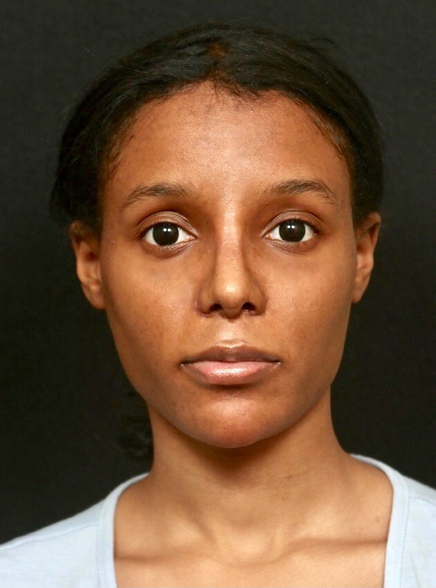 Rhinoplasty Before and After After