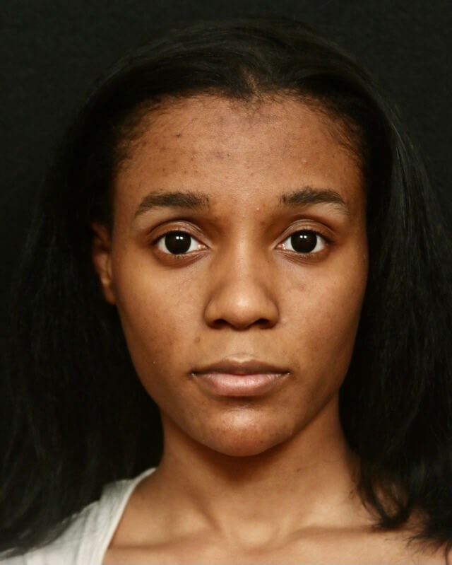 Rhinoplasty Before and After Before