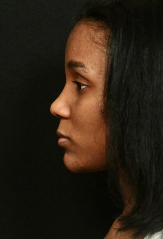 Rhinoplasty Before and After Before