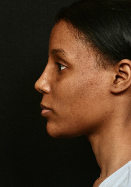 Rhinoplasty Before and After After