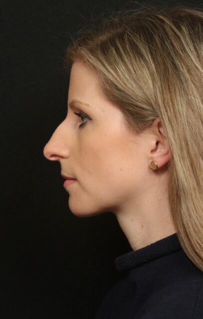 Before And After Rhinoplasty Before