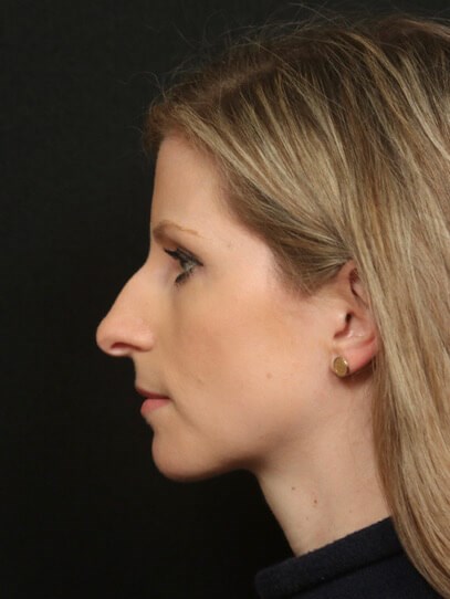 Before And After Rhinoplasty Before