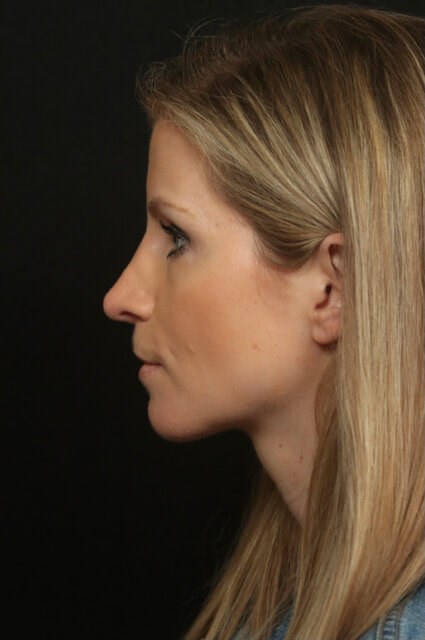 Before And After Rhinoplasty After