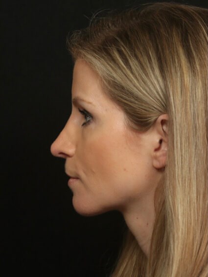 Before And After Rhinoplasty After