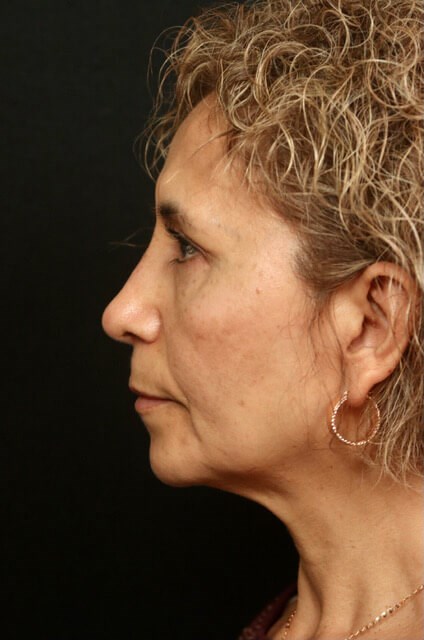 Before and After Rhinoplasty After