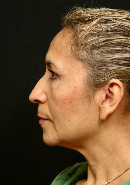 Before and After Rhinoplasty Before