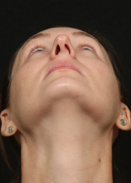 Rhinoplasty Before And After Before