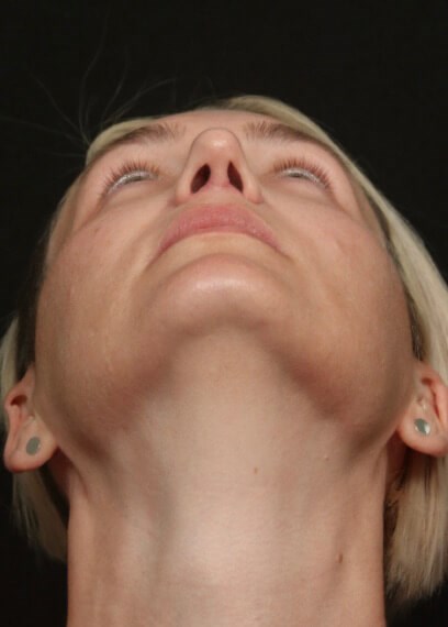 Rhinoplasty Before And After After