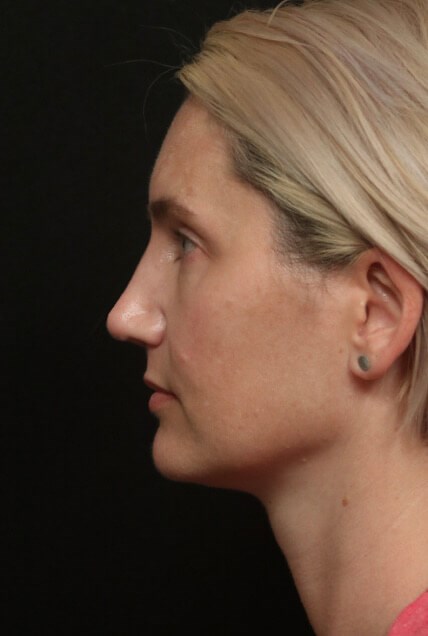 Rhinoplasty Before And After After