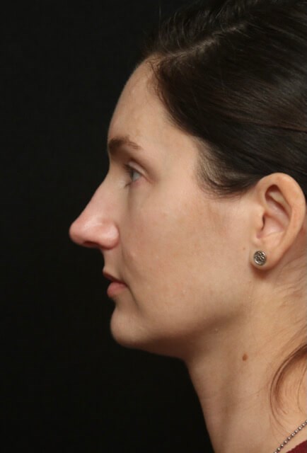 Rhinoplasty Before And After Before