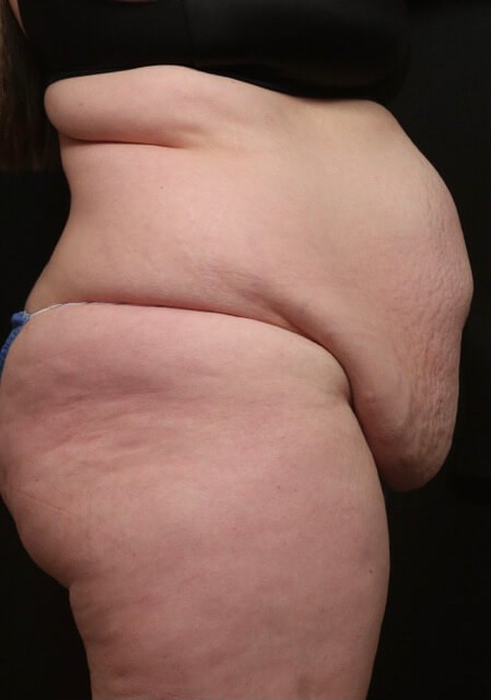 Tummy Tuck Before and After Before