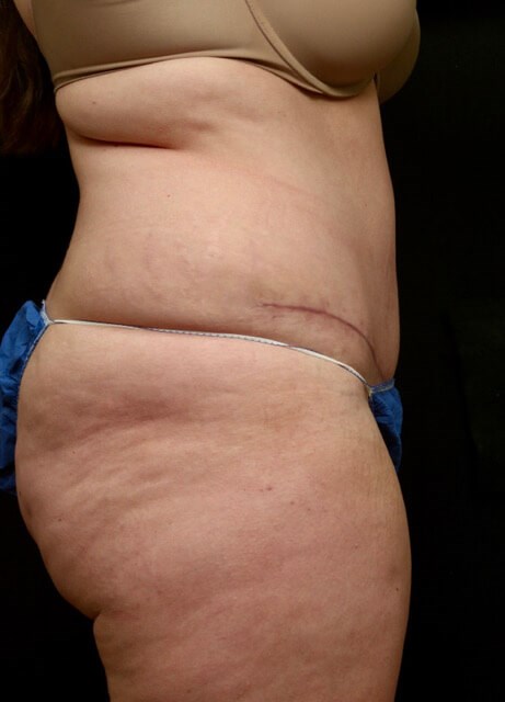 Tummy Tuck Before and After After