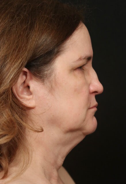 Facelift Before And After Before