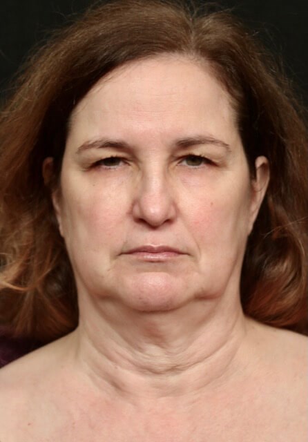 Facelift Before And After Before