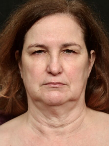 Facelift Before And After Before