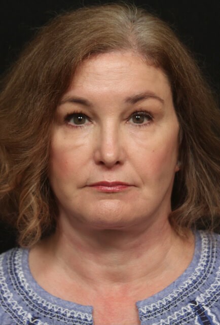 Facelift Before And After After